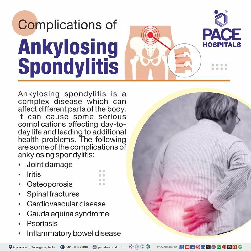 Complications of Ankylosing Spondylitis Ankylosing spondylitis complications |
complications of ankylosing spondylitis