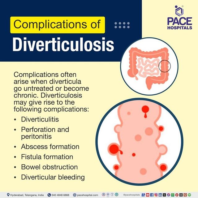 Diverticulosis