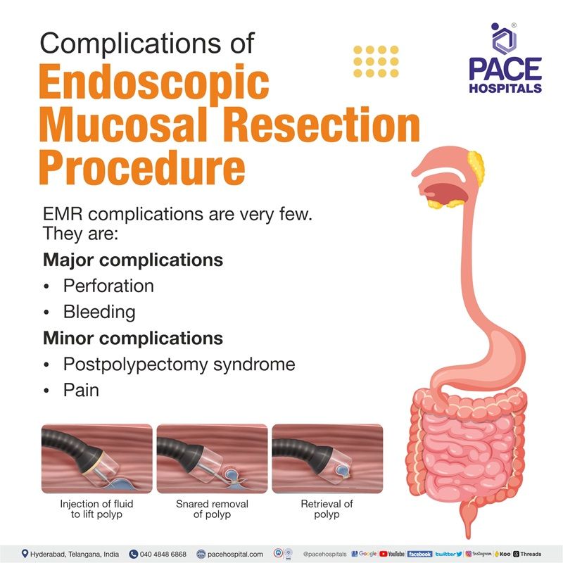 EMR endoscopic mucosal resection complications endoscopic mucosal resection complications | endoscopic mucosal resection colon polyps barrett's esophagus | endoscopic mucosal resection doctors in Hyderabad, India | endoscopic mucosal resection near me