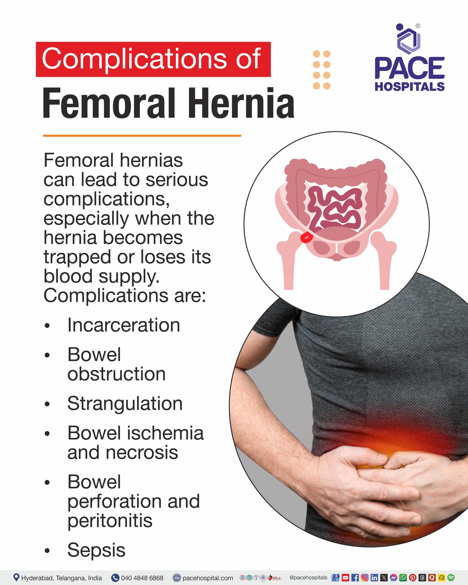 Complications of Femoral Hernia Complications of Femoral Hernia I Femoral Hernia Complications I femoral hernia repair complications