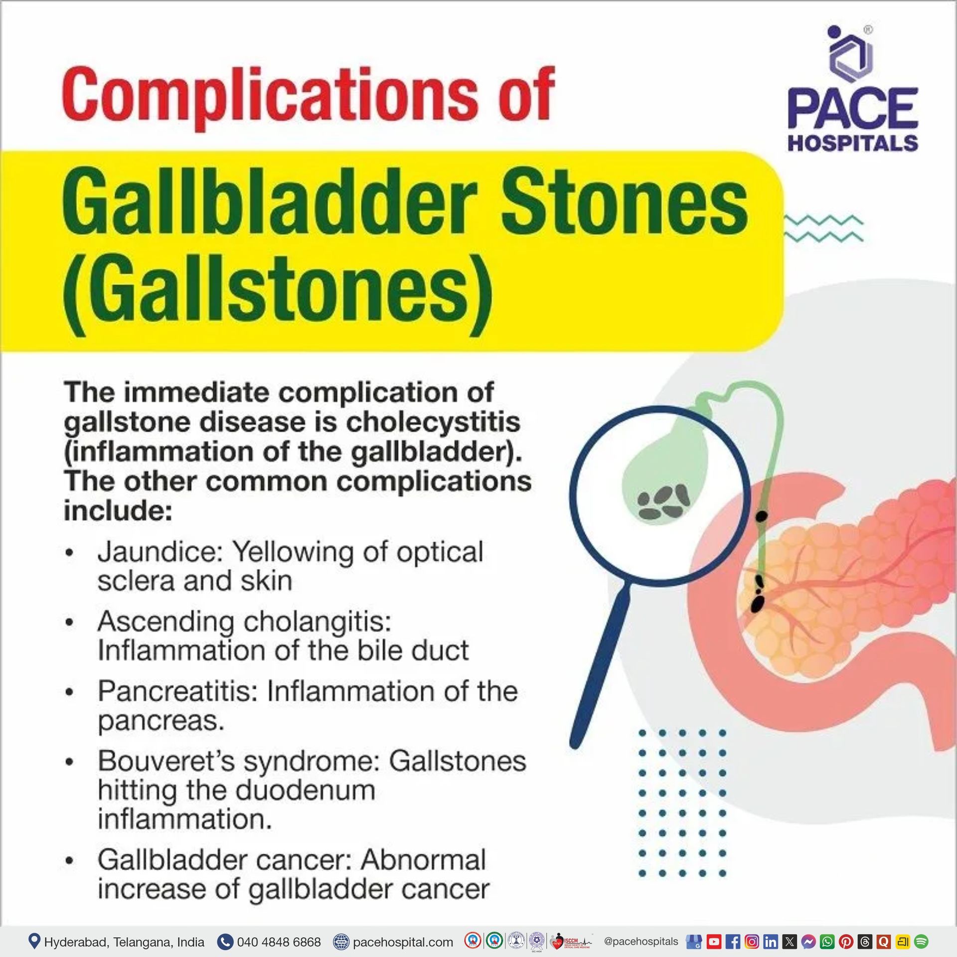 gallbladder stones complications | complications of gallstones | complicated gallstone disease | complications of gall stone
