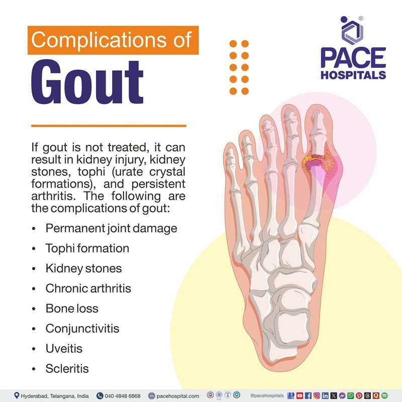 Complications of Gout Complications of Gout | Gout Complications