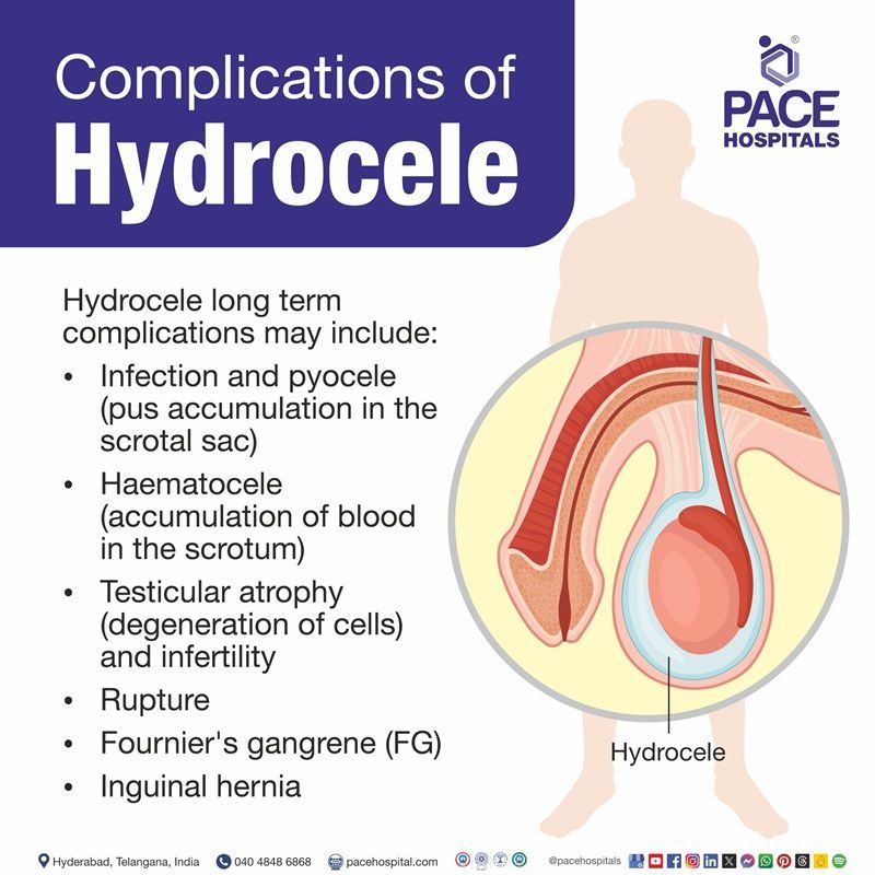 Hydrocele complications hydrocele complications | What are the complications of hydrocele | hydrocele after surgery complications | Visual depicting the complications of Hydrocele