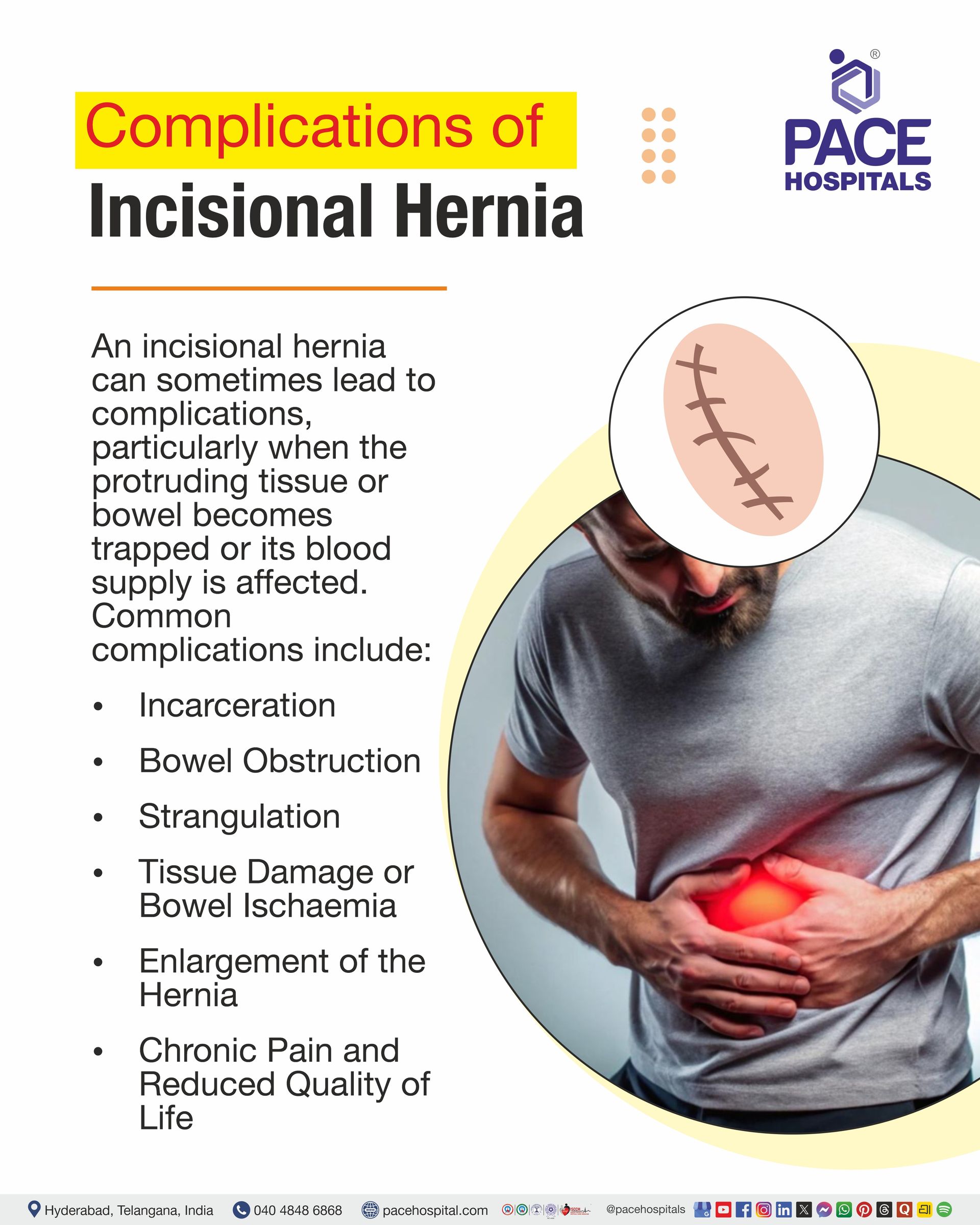 Complications of Incisional Hernia Incisional Hernia Complications I Complications of Incisional Hernia