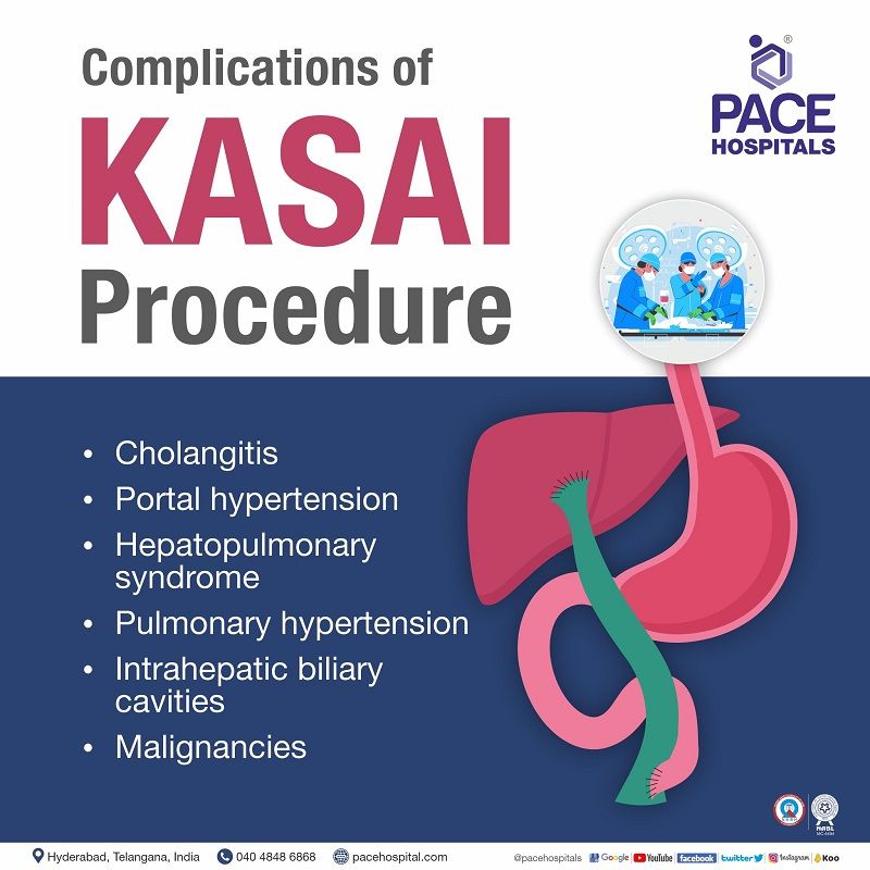 complications of kasai procedure kasai procedure complications | liver transplant after kasai procedure | biliary atresia failed kasai procedure | kasai procedure liver