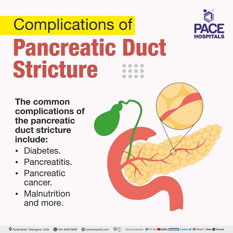 Pancreatic Duct Stricture Complications Complications of Pancreatic Duct Strictures | Benign and Malignant Pancreatic Ductal Strictures Complications