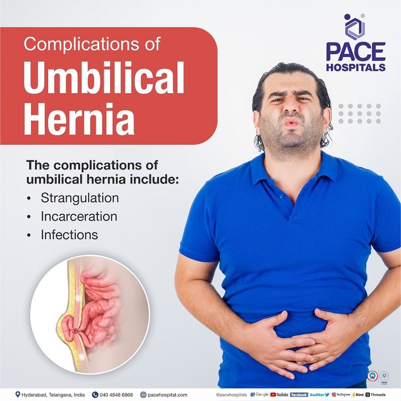 Complications from Umbilical Hernia umbilical hernia complications, India | umbilical hernia risk | umbilical hernia strangulation risk | chances of umbilical hernia strangulation | umbilical hernia problems