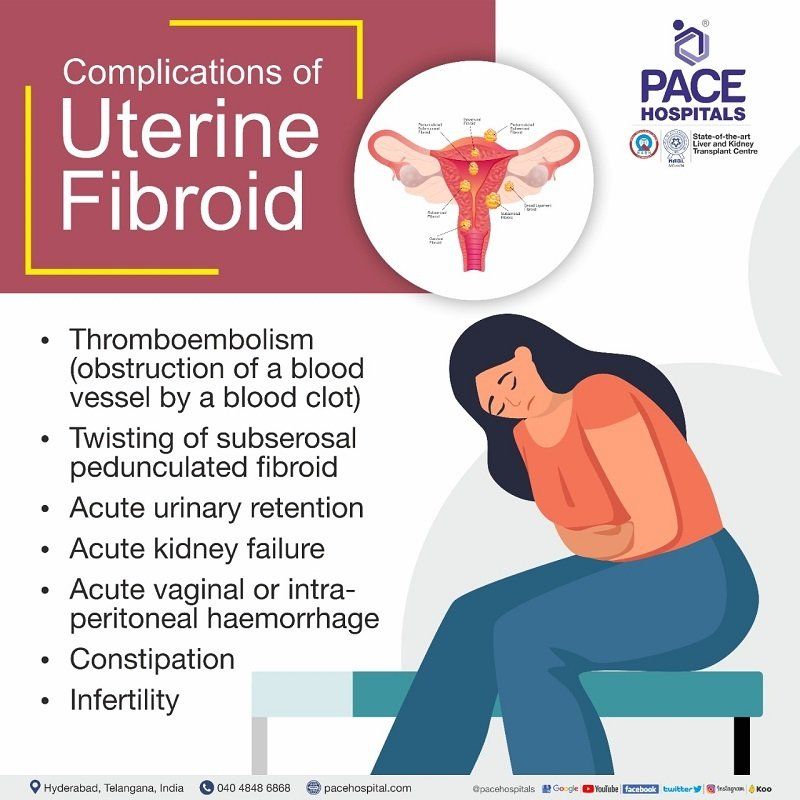 Complications of Uterine Fibroids Complications of Uterine Fibroids