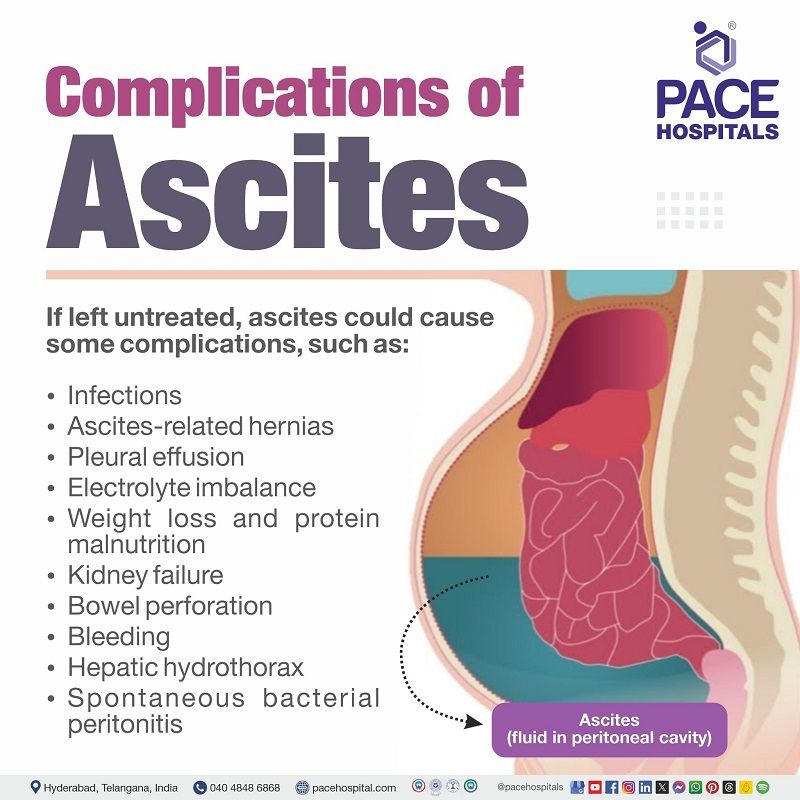Ascites Complications Ascites Complications | complications of ascites | types of ascites complications | What are the complications of ascites | Visual narrating the complications of Ascites
