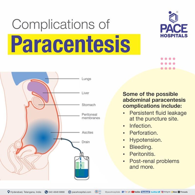paracentesis complications abdominal paracentesis complications | ascites tapping complications | ascitic fluid tapping complications | complications of ascites tapping procedure