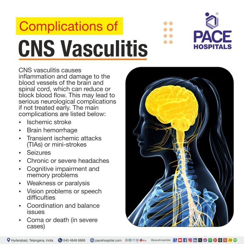 Central Nervous System (CNS) Vasculitis Complications Central Nervous System Vasculitis Complications | CNS Vasculitis Complications
