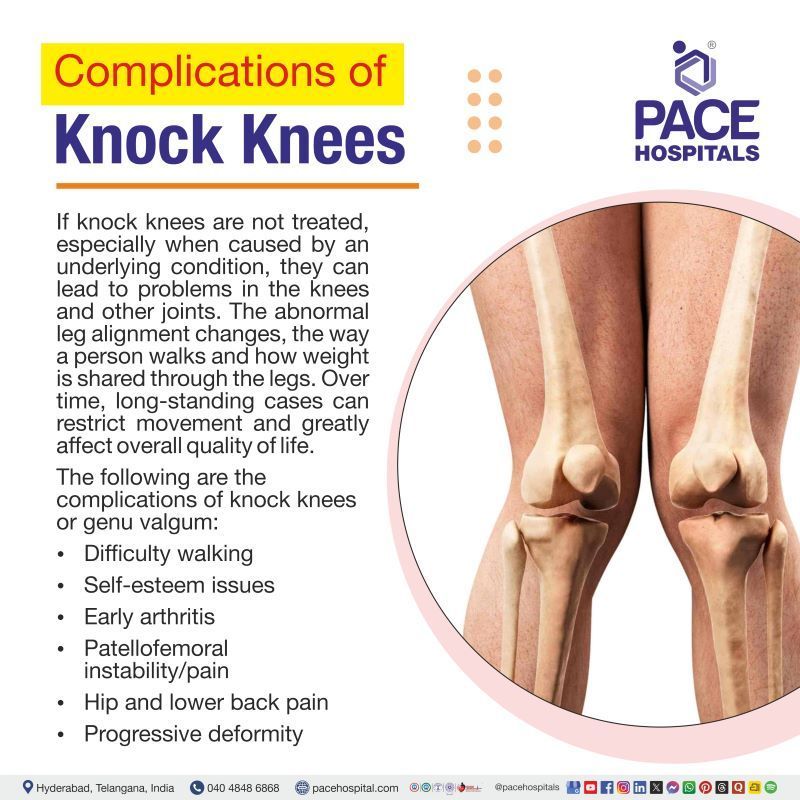 Knock Knees (Genu Valgum) Complications Knock knees Complications | Complications of genu valgum | Genu valgum complications | Complications of Knock knees