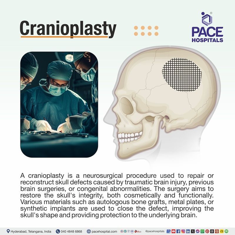 Cranioplasty Meaning What is a Cranioplasty | Cranioplasty Procedure | Cranioplasty Surgery