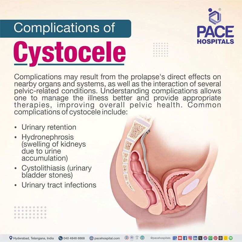 Complications of cystocele cystocele complications | complications of cystocele | What are the complications of Cystocele | Visual revealing the complications of Cystocele