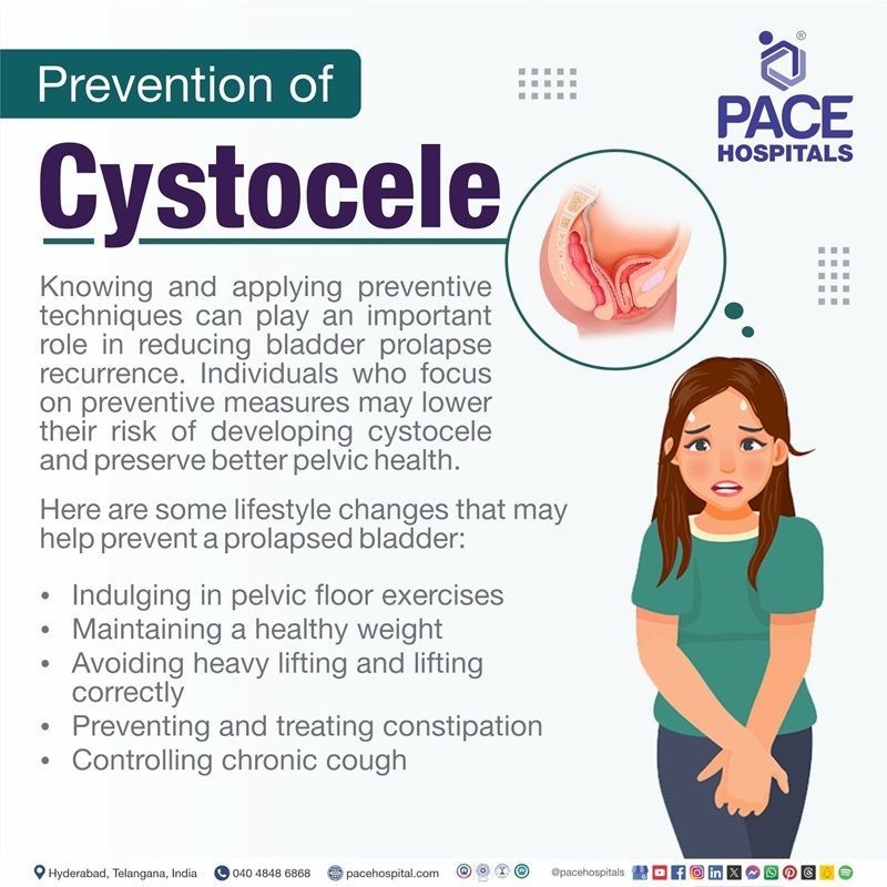 Preventions of Cystocele Cystocele prevention | preventions of Cystocele | Cystocele preventive measures | Visual depicting the preventive measures of Cystocele