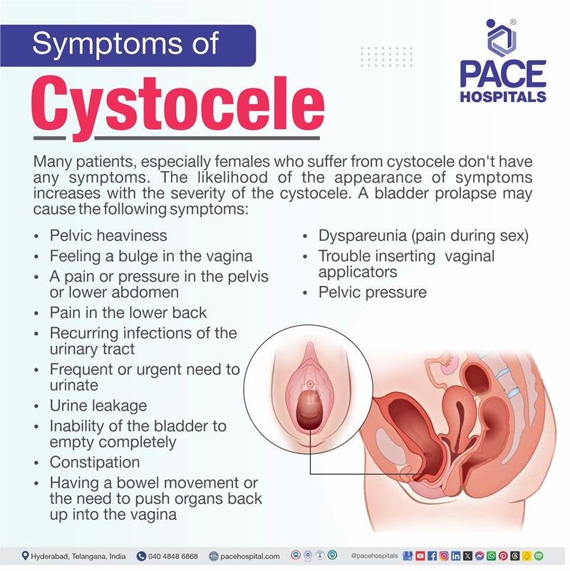 Symptoms of Cystocele cystocele symptoms | cystocele prolapse symptoms | male cystocele symptoms | Symptoms of Cystocele | Visual showing the symptoms of Cystocele