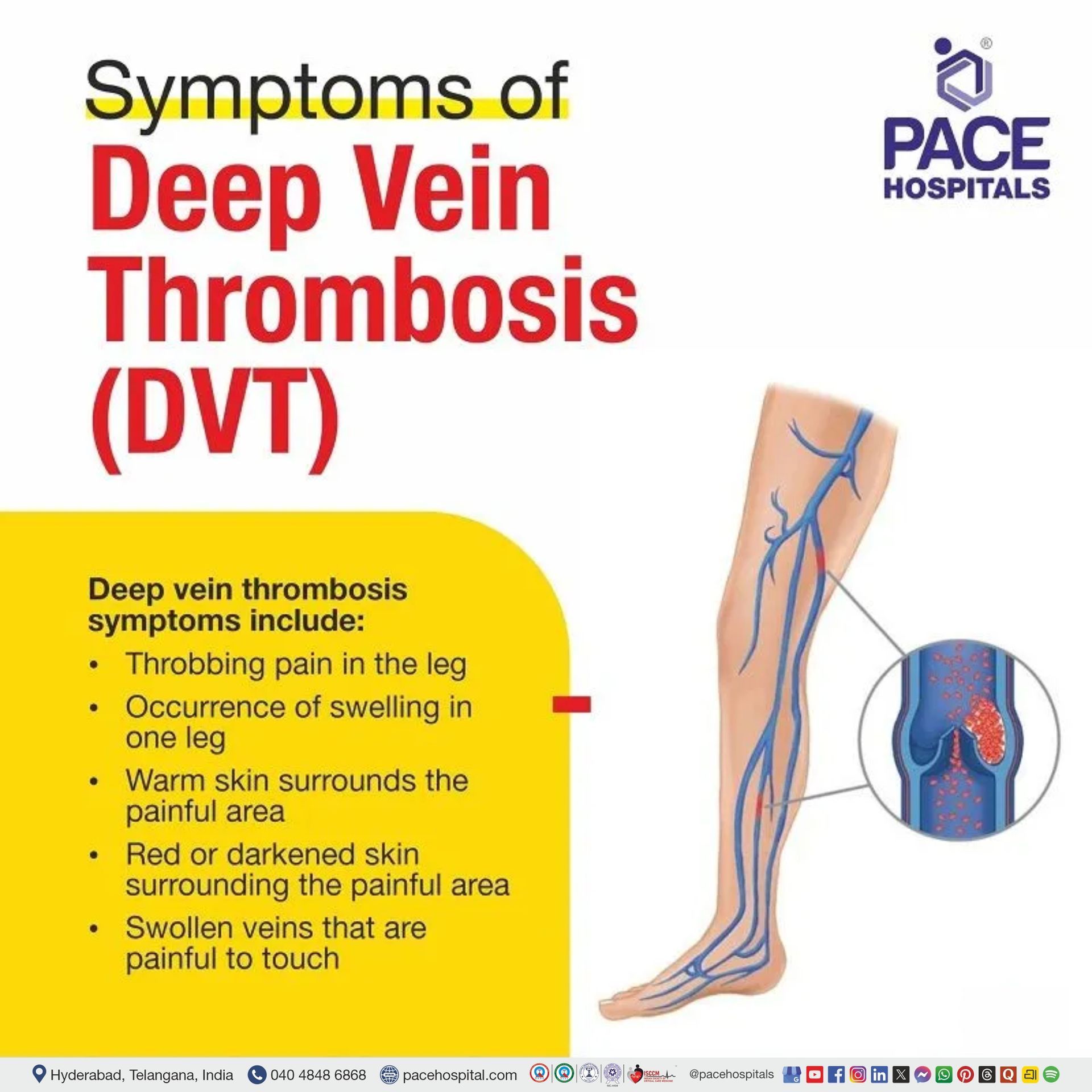 dvt symptoms | deep vein thrombosis symptoms | early stage dvt signs and symptoms leg | dvt and pe symptoms | deep vein thrombosis signs and symptoms