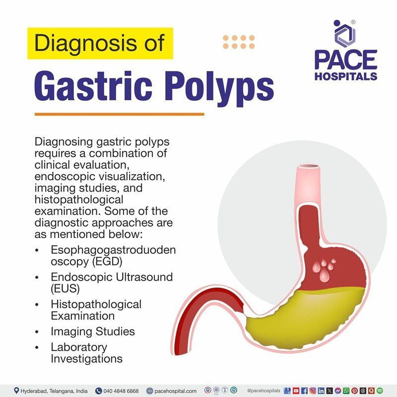 Gastric Polyps Diagnosis | Visual showing the various approaches for gastric polyps diagnosis