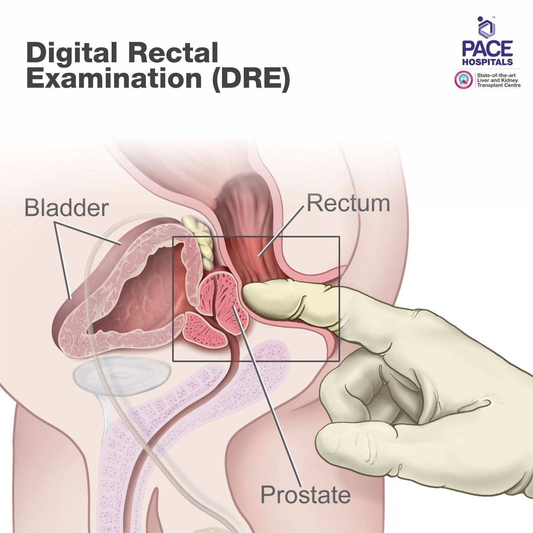 Digital rectal examination (DRE) Digital rectal examination (DRE)