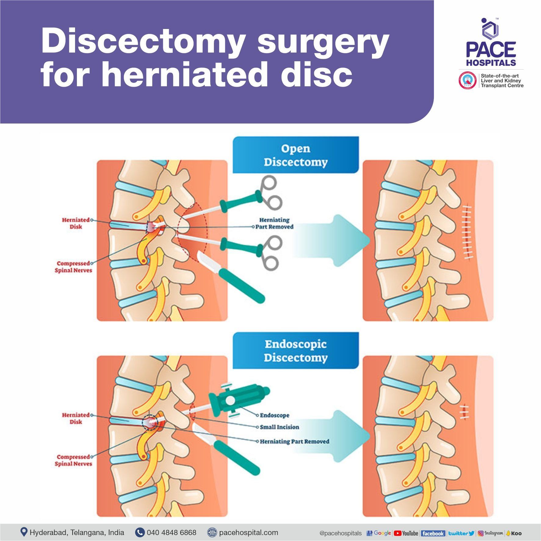 Discectomy surgery for herniated disc Discectomy surgery for herniated disc in Hyderabad, Telangana, India