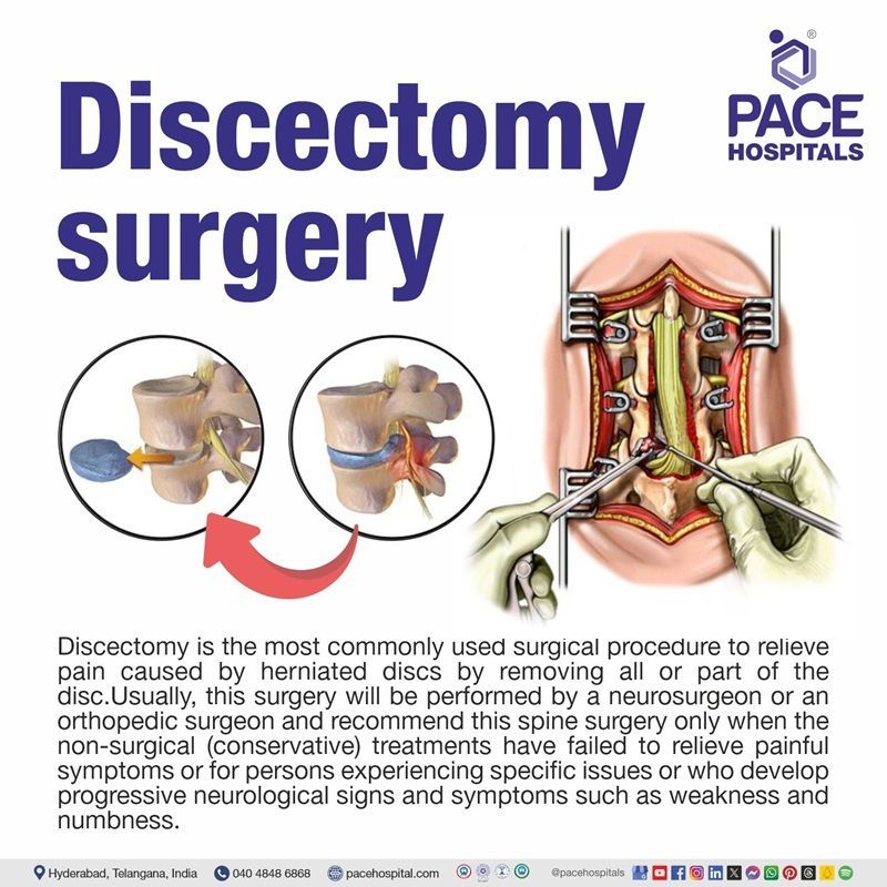 What is Discectomy surgery or procedure Discectomy surgery meaning | Discectomy surgery in Hyderabad | best Discectomy surgery hospitals in Hyderabad India