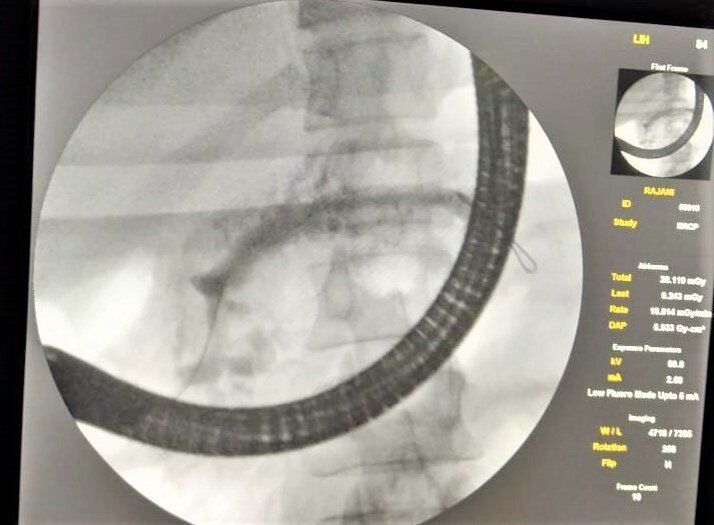 ERCP with pancreatic duct stent placement for chronic pancreatitis patients