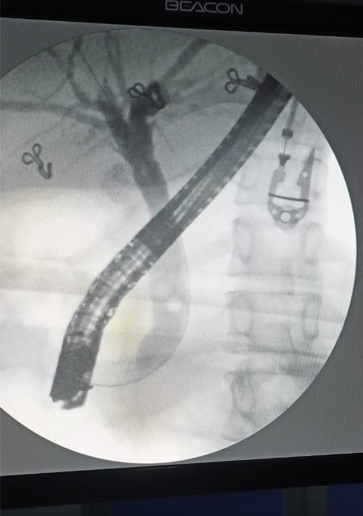 EUS for common bile duct stone