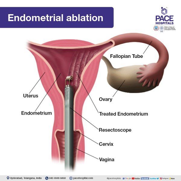 Endometrial Ablation for Uterine Fibroids Treatment Endometrial Ablation in Hyderabad | Uterine Ablation | Uterine Fibroids Treatment