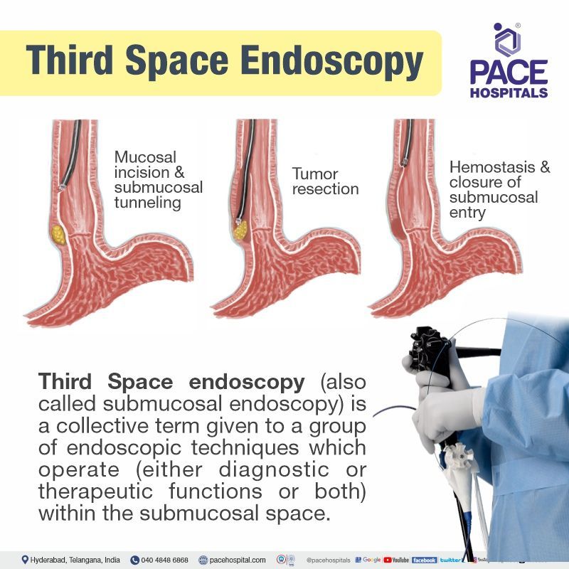 Endoscopic Resection and Third Space Endoscopy technique What is Third Space Endoscopy technique | Best Hospital for Endoscopic Resection and Third Space Endoscopy in Hyderabad, India | Third Space Endoscopy near me