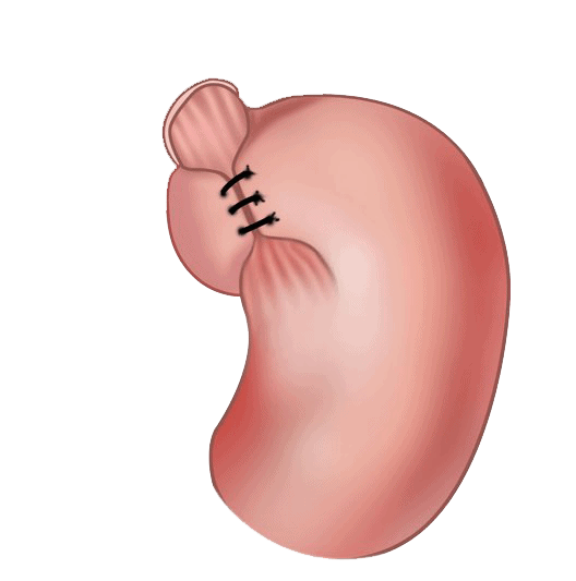 Endoscopic fundoplication and Open / Laparoscopic Nissen fundoplication in GERD management Endoscopic fundoplication and Open / Laparoscopic Nissen fundoplication in GERD management