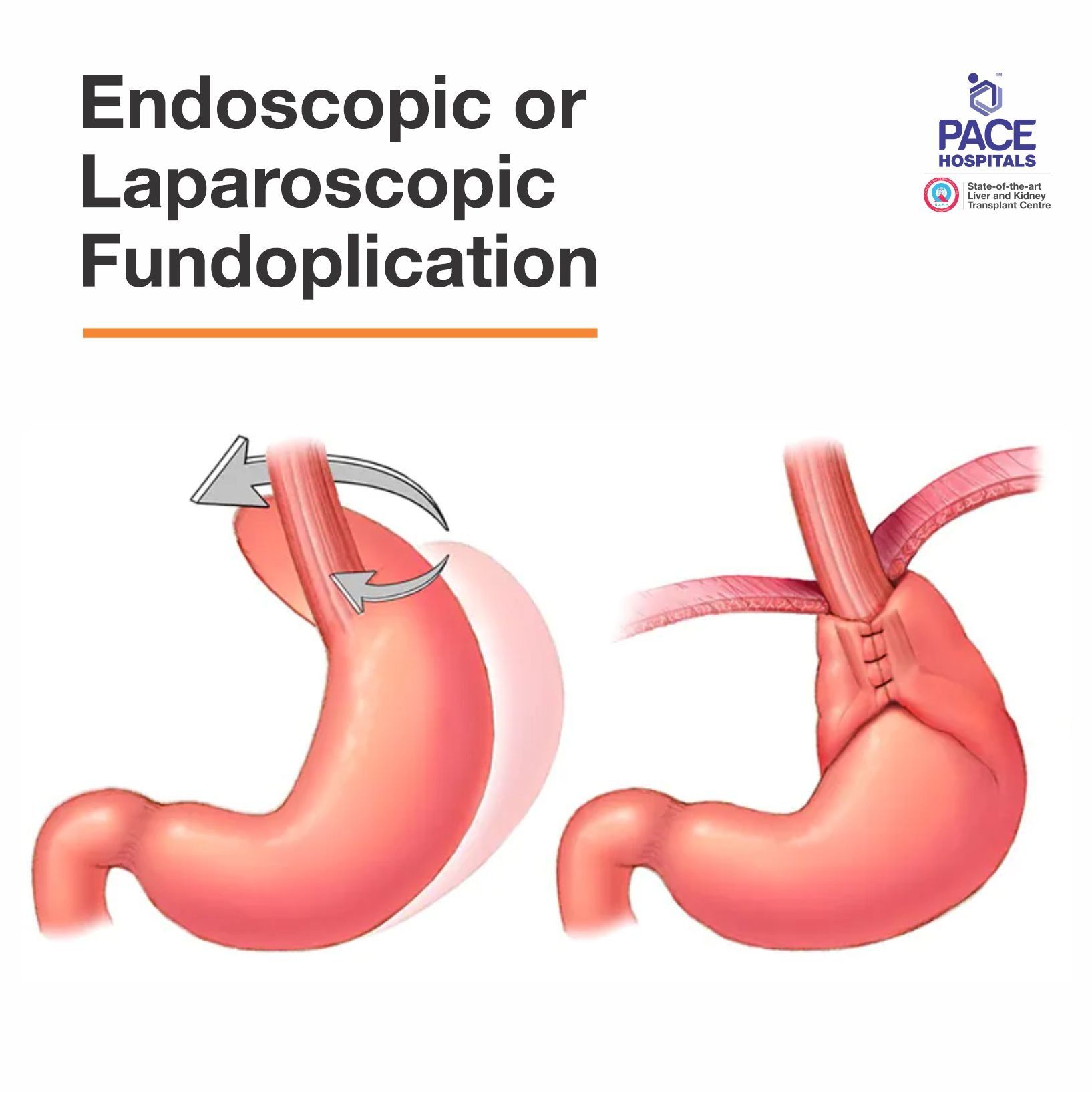 before and after laparoscopic fundoplicating