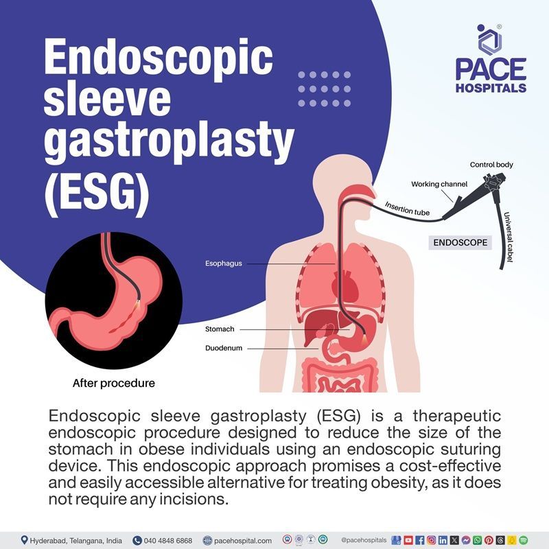 What is Endoscopic Sleeve Gastroplasty (ESG) endoscopic sleeve gastroplasty ESG definition | ESG endoscopic sleeve gastroplasty price in Hyderabad | Best Endoscopic Sleeve Gastroplasty hospital in Hyderabad India