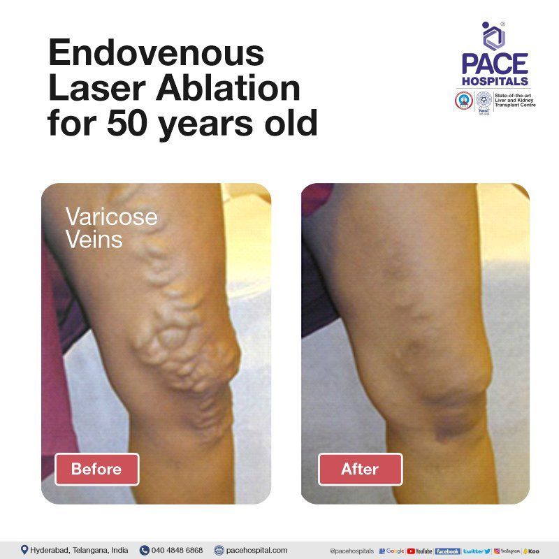 Endovenous laser ablation for varicose veins treatment in hyderabad | varicose vein surgery