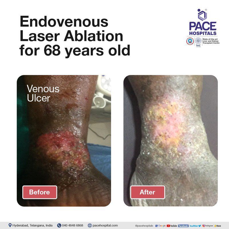 Endovenous thermal ablation for venous ulcer treatment in hyderabad | varicose vein surgery