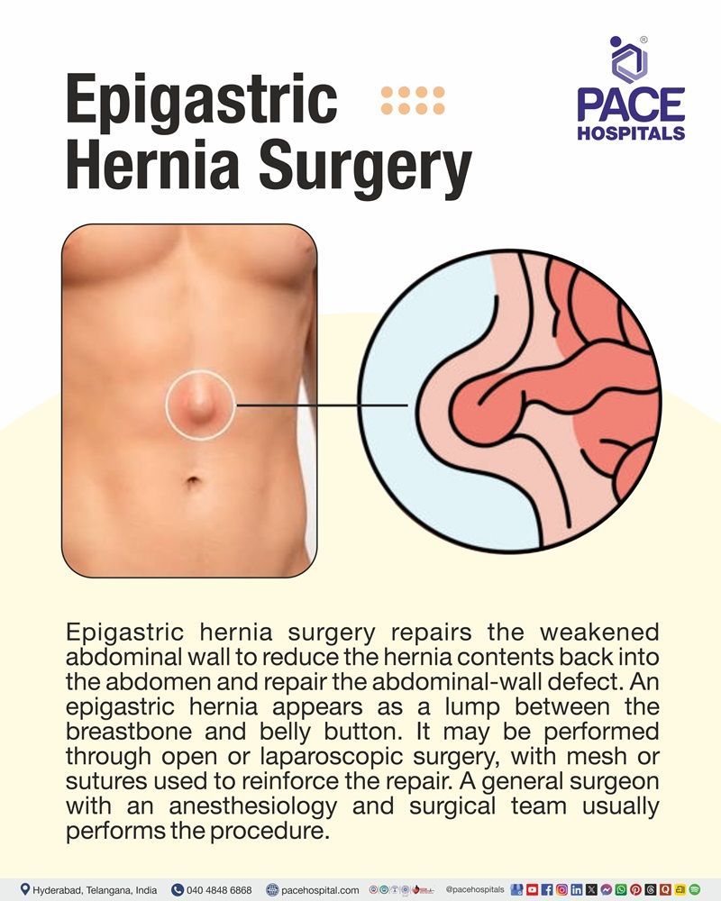 Epigastric Hernia Surgery Meaning Epigastric hernia surgery with illustrations of the abdominal bulge, hernia anatomy, and surgical repair options.