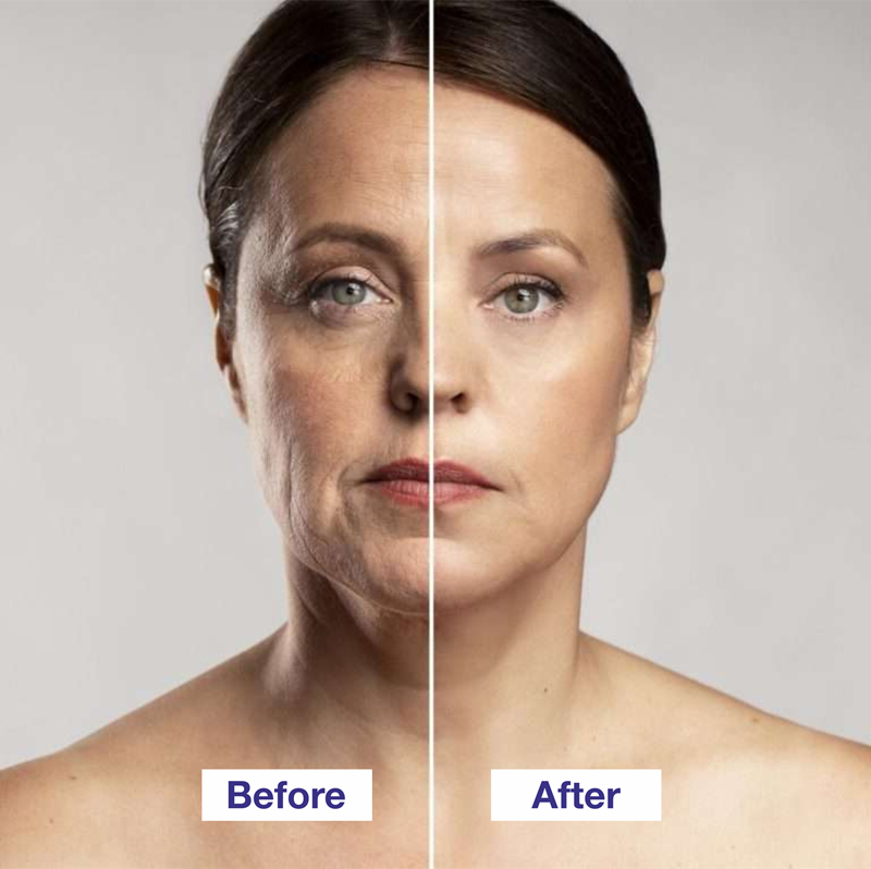 Rhytidectomy before and after | Facelift Surgery before and after in Hyderabad, Telangana, India