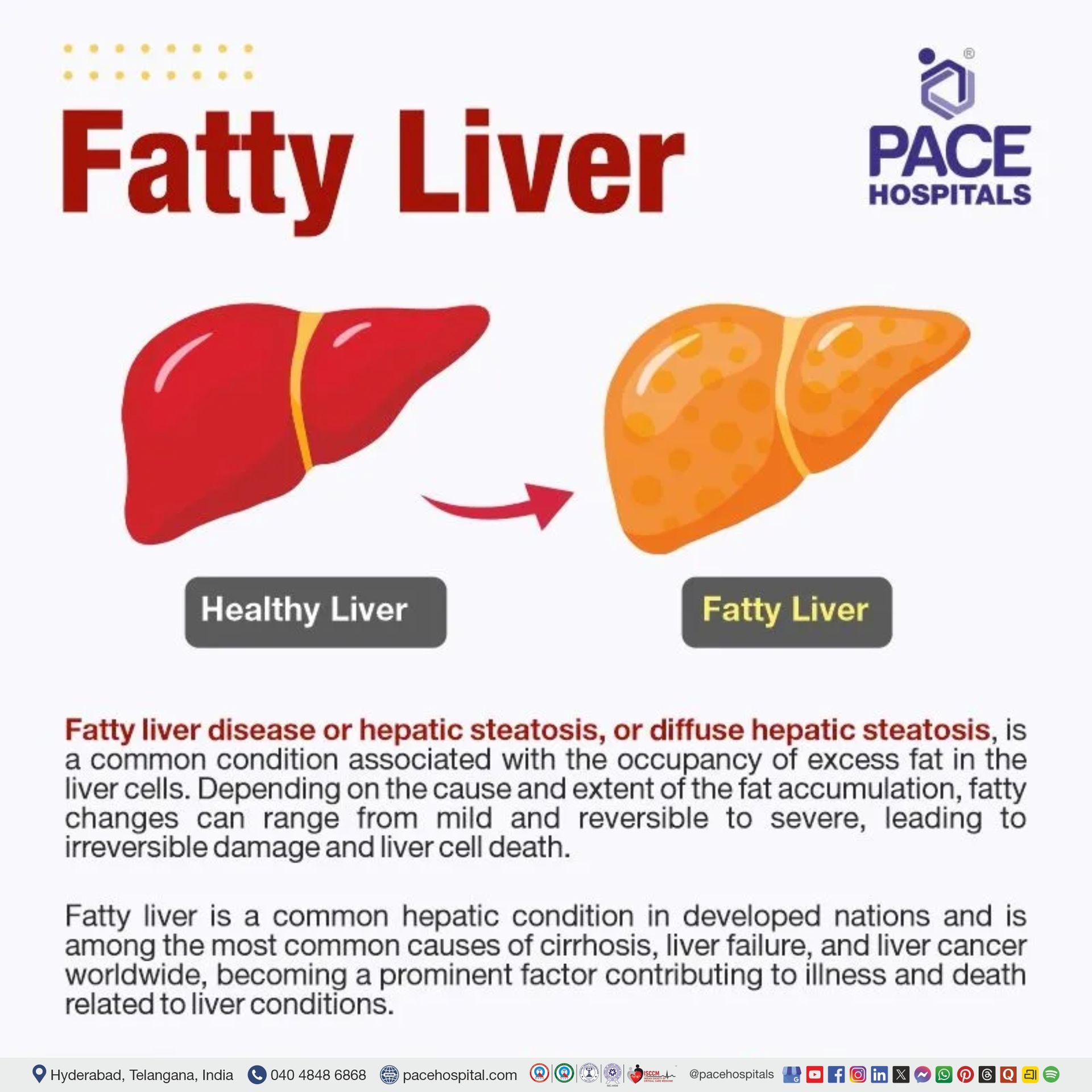 fatty liver means | nonalcoholic fatty liver disease | fatty liver disease | alcoholic fatty liver disease