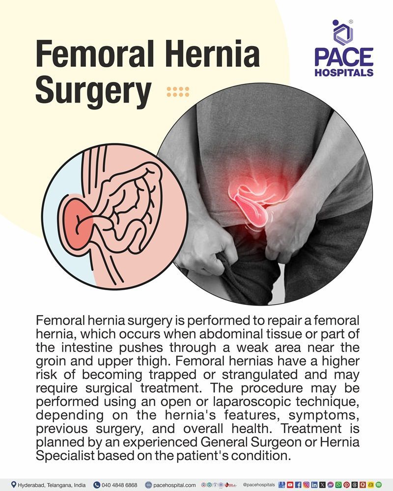 Femoral Hernia Surgery Meaning Visual depicting Femoral hernia surgery procedure to repair a hernia near the groin and upper thigh using open or laparoscopic techniques