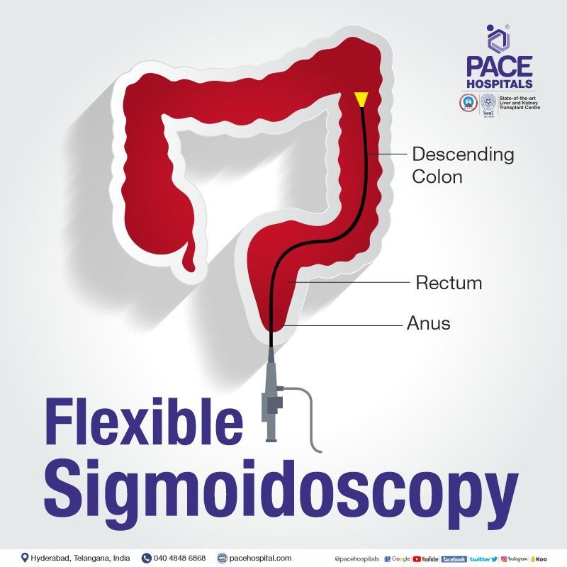Flexible sigmoidoscopy test and procedure in Hyderabad, India with cost and fiberoptic details