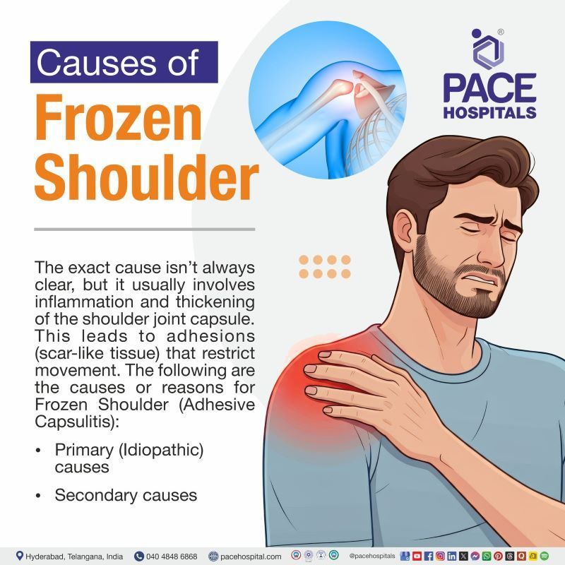 Frozen Shoulder Causes | What causes frozen shoulder | Causes of frozen shoulder