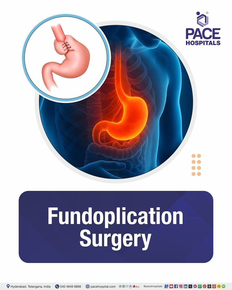 Fundoplication Surgery Cost in Hyderabad | Affordable Fundoplication Surgery in India