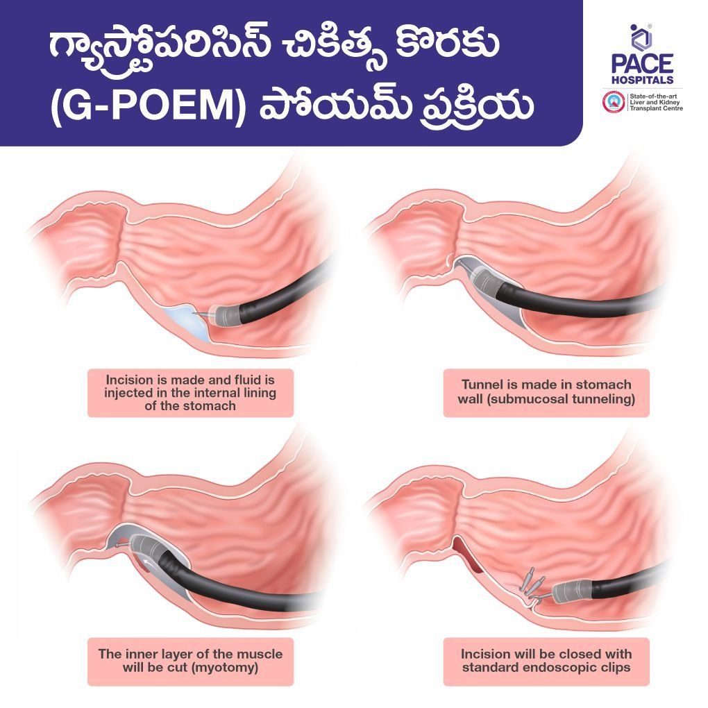 G-POEM for gastroparesis in telugu g-poem surgery in telugu, g-poem procedure in telugu, Gastric Peroral Endoscopic Myotomy (G-POEM) for gastroparesis treatment in telugu