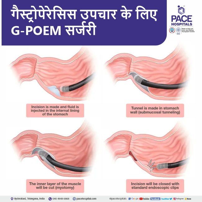 G-POEM for gastroparesis Gastric Peroral Endoscopic Myotomy G-POEM for gastroparesis treatment in Hindi