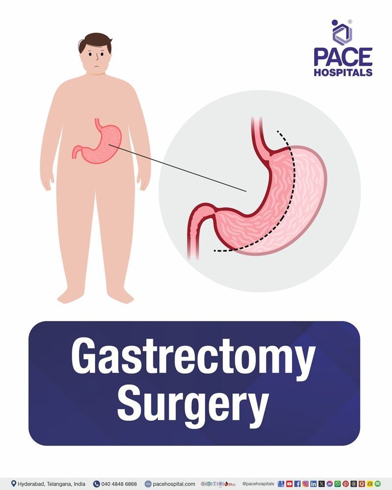 Gastrectomy Surgery Cost in Hyderabad | Affordable Gastrectomy Surgery in India