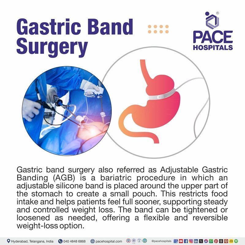 Gastric Band Surgery Meaning What is lap band surgery | adjustable gastric band surgery