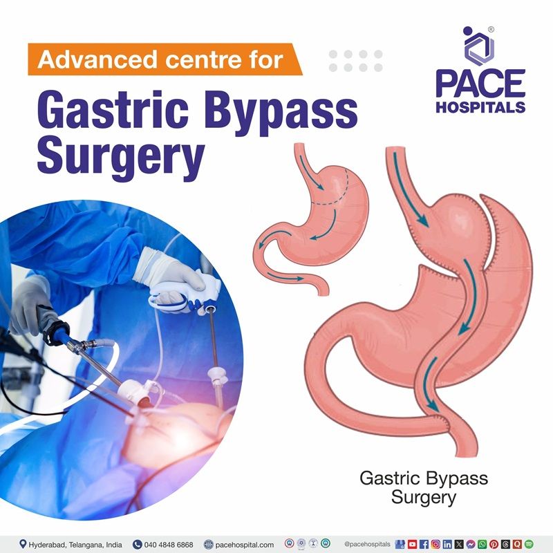 Best Hospital for Roux-en-Y Gastric Bypass in Hyderabad, India Best Hospital for Gastric Bypass surgery in Hyderabad | Roux en y gastric bypass Surgery in Hyderabad, India