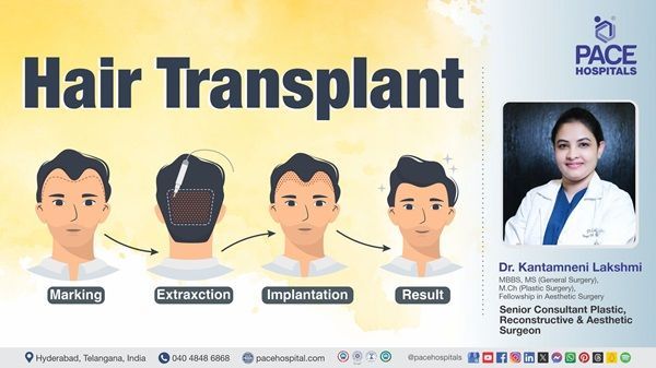 Dr. Kantamneni Lakshmi from PACE Hospitals explains hair transplant types, benefits & side effects