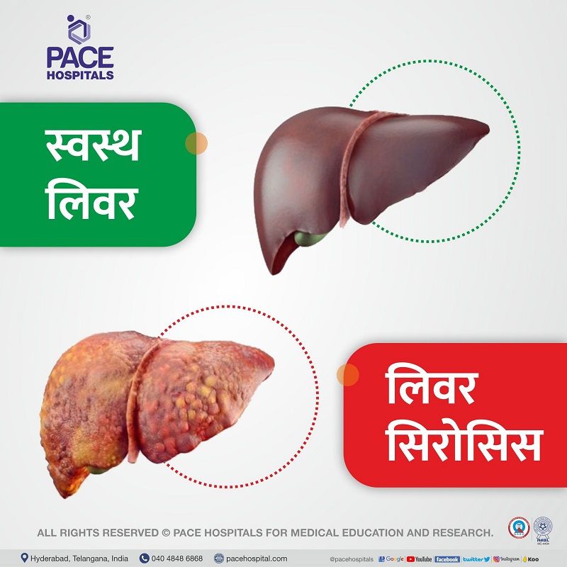 healthy liver vs liver cirrhosis hindi Indications for liver transplant in hindi | healthy liver and liver cirrhosis in hindi