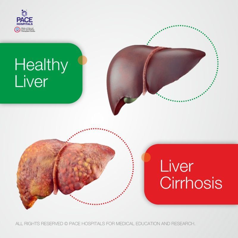 Healthy liver vs Liver cirrhosis Indications for liver transplant surgery | healthy liver and liver cirrhosis before and after liver transplant