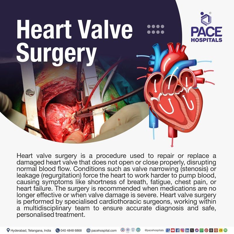 What is Heart Valve Surgery? What is heart valve surgery? | Heart Valve Replacement and Repair Surgery